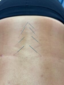 Dry needling